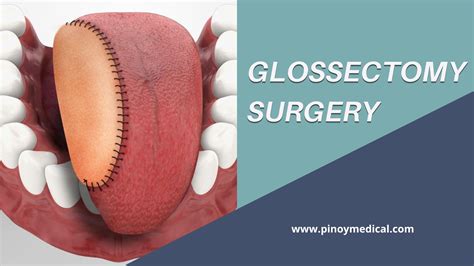glossectomy vula|glossectomy cost.